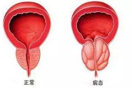 前列腺炎癥能否自愈，解析、理解與應對，前列腺炎癥能否自愈，解析、應對及理解指南