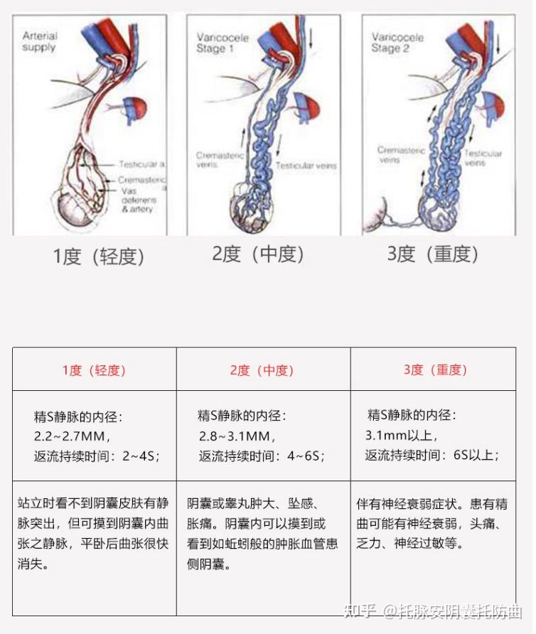 精索靜脈曲張三個(gè)程度圖詳解，精索靜脈曲張三個(gè)程度詳解圖解