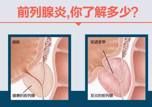 前列腺炎的治愈可能性，理解與探索，前列腺炎的治愈可能性，深入理解與探索