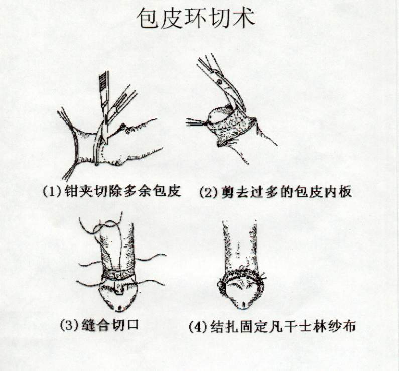 關(guān)于包皮手術(shù)后多久可以同房的問題解答，包皮手術(shù)后恢復(fù)與同房時間指南