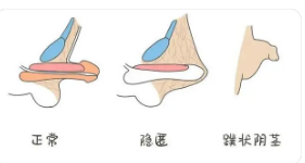 正規(guī)包莖手術費用詳解，正規(guī)包莖手術費用全面解析