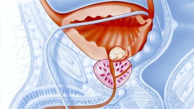前列腺炎的治療費(fèi)用分析，前列腺炎治療費(fèi)用詳解