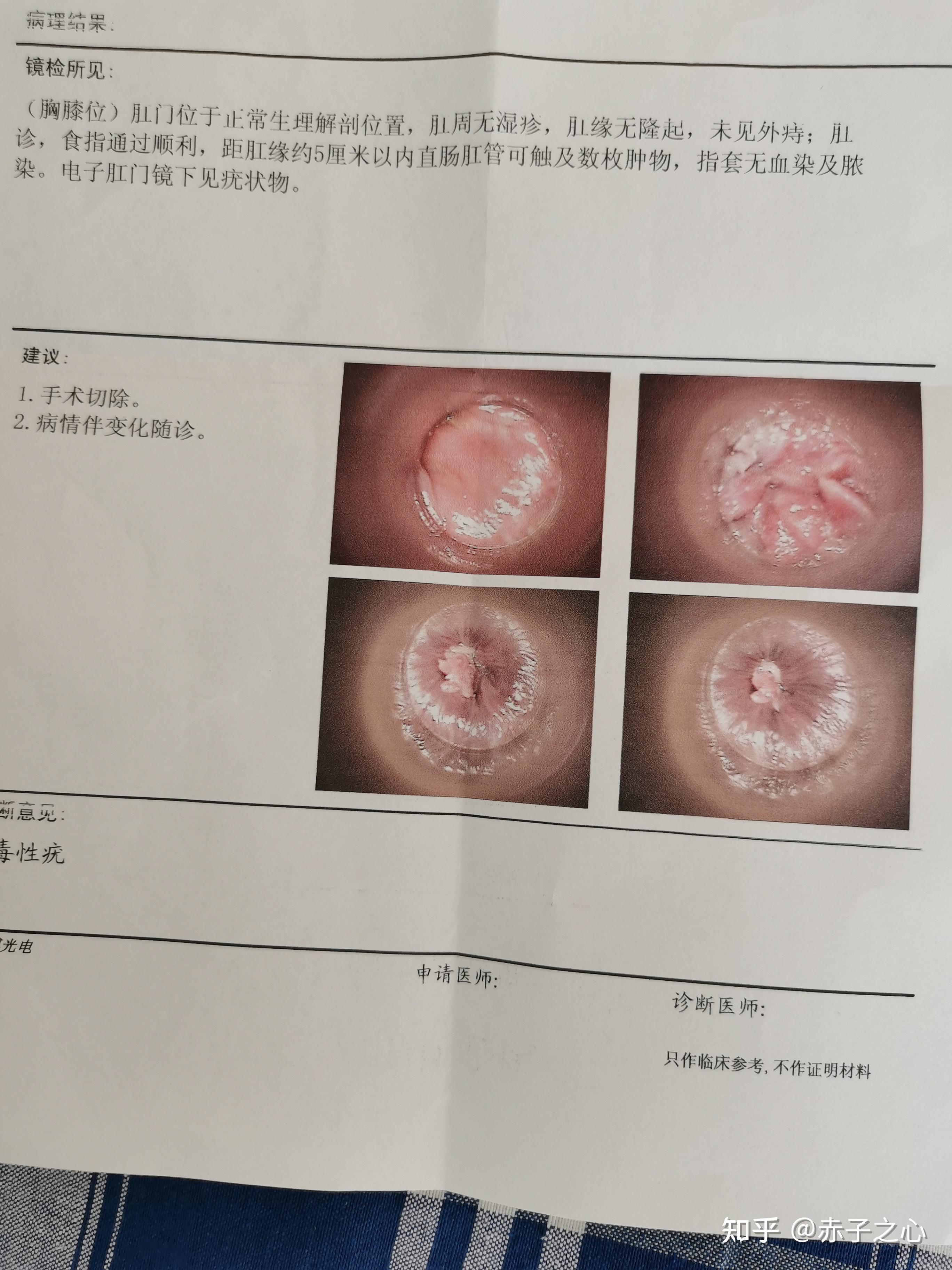 患者尖銳治愈的真實(shí)過程，患者尖銳濕癥的治愈之路