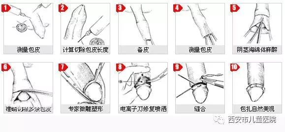 關(guān)于做包皮手術(shù)是否疼痛，一種全面的解讀與應(yīng)對(duì)建議，包皮手術(shù)疼痛解讀及應(yīng)對(duì)建議，全面解析與指導(dǎo)